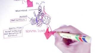 Emphysema  Introduction Types Symptoms Diagnosis [upl. by Ahsyt]