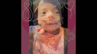 Katierae Trisomy 18 Awareness [upl. by Enyrb34]