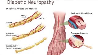 Common Cause of Foot Numbness  Diabetic Peripheral Neuropathy [upl. by Kcered]