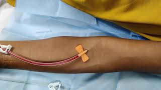 First time Cannulation of AV Fistula [upl. by Nibroc]