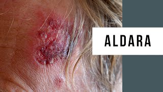 Skin Cancer Treatment Using Aldara Cream [upl. by Hachmann]