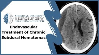 Subarachnoid Hemorrhage SAH Computed Tomography Scan Findings [upl. by Fotinas62]