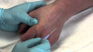 Intravenous Catheter Placement [upl. by Lesab]