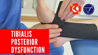 Taping painful TIBIALIS POSTERIOR TENDON [upl. by Geno]