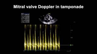 Echocardiography Essentials Detecting pericardial effusions [upl. by Heeley]