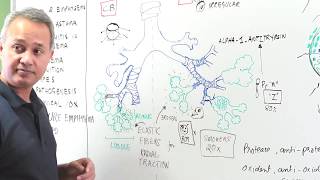 Emphysema  Clinical Presentation Diagnosis and Management [upl. by Itsim]