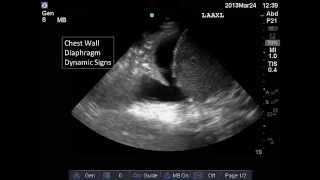 Lung and Pleural Ultrasound Interpretation [upl. by Einaffyt]