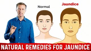 Neonatal Jaundice  Causes Symptoms and Treatment [upl. by Heppman]