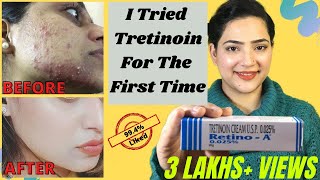 Retino A 0025cream Review  Before And After Tretinoin Cream Review  My experience with Tretinoin [upl. by Alat]