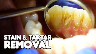 Dental Cleaning EXPLAINED  Stain amp Tartar Removal [upl. by Aven]