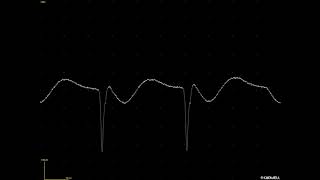 Waxingwaning discharge from a denervated muscle [upl. by Merv]