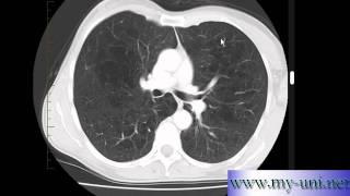 Emphysema on CT scan of Chest [upl. by Aticilef129]