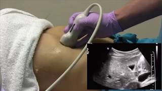 How I do it Ultrasound of the Abdomen [upl. by Sebastien958]