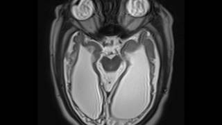 Periventricular Leukomalacia [upl. by Pang]