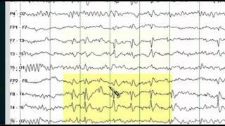 Focal EEG Abnormalities 1 [upl. by Aivekahs]