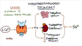 Understanding Hyperparathyroidism [upl. by Nnyleimaj]