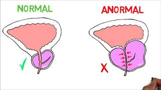 Hiperplasia prostática benigna HPB Fisiopatología Anatomía y Síntomas [upl. by Eirruc671]