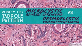 Microcystic Adnexal Carcinoma vs Desmoplastic Trichoepithelioma Paisley TieTadpole Pattern [upl. by Gyatt388]