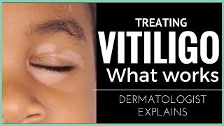 Vitiligo treatments what works [upl. by Yllah118]