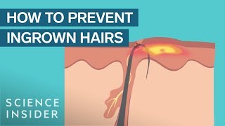 What Are Ingrown Hairs — And How To Treat Them [upl. by Dev829]