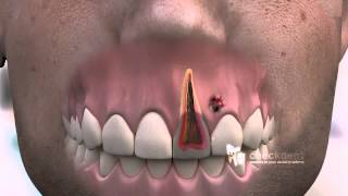 How to treat a dental Fistula [upl. by Teriann401]