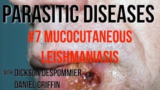 Parasitic Diseases Lectures 7 Mucocutaneous Leishmaniasis [upl. by Olympia]