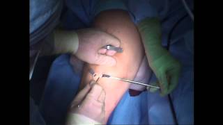 ACL Surgery  First Incision [upl. by Nomyt]