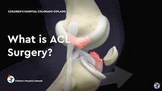 ACL surgery Graft options [upl. by Emogene9]