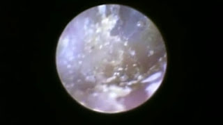 Dust Mites In Human Ears Feed On Skin [upl. by Fiden]