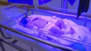 Newborn Jaundice [upl. by Salina]