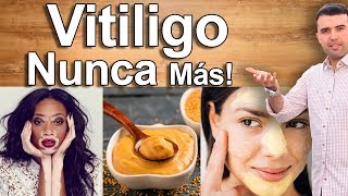 COMO CURAR EL VITILIGO  Tratamiento Natural Con Remedios Caseros Para el Vitiligo [upl. by Hailed]