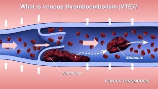 Mechanical Thrombectomy  Neurovascular stent deployment [upl. by Bourque]