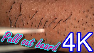 Beard removal tweezers super high quality zoom ASMR [upl. by Sadiras45]