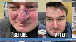 Surgical Treatment of Rhinophyma Complete Excision and Reconstruction [upl. by Huebner]