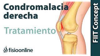 Tratamiento de la condromalacia rotuliana derecha [upl. by Hsirk]