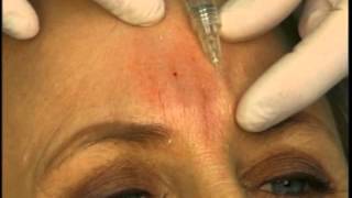 Dr Elliott Shows How to Fill Frown Glabella Lines With A Dermal Filler [upl. by Eiduam942]