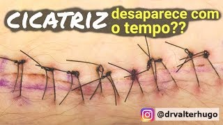 CICATRIZ Desaparece  Como Tirar Cicatrizes Dr Valter Hugo [upl. by Okimuk]