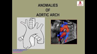 Ultrasound of normal early pregnancy [upl. by Airbmac]