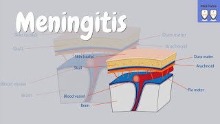 Meningitis bacterial vs viral symptoms Kernigs sign clinical clues meningococcal infection [upl. by Anomar]