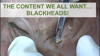 The content we all wantBlackheads  Dr Derm [upl. by Swagerty]