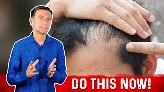 Receding Hairline Causes And Remedies – DrBerg [upl. by Ecyt]