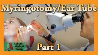 Myringotomy amp Ear Tube Part 1 Feat Dr Tim Fife  Myringotomy  Auburn Medical Group [upl. by Anna-Diane]