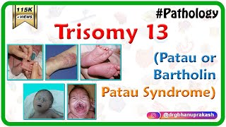 Trisomy 13 Patau or BartholinPatau syndrome  Causes  Diagnosis  Treatment [upl. by Ahsikcin]