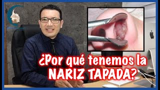 6 CAUSAS más comunes de OBSTRUCCIÓN NASAL y como resolverlo  PlasticFacial MX [upl. by Lamdin242]