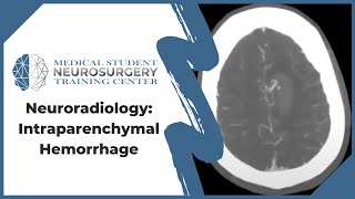 Neuroradiology Intraparenchymal Hemorrhage [upl. by Stilla]