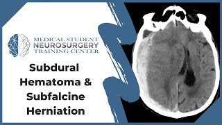 Subdural Hematoma amp Subfalcine Herniation [upl. by Ahcsim]