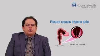 Piles Fissures amp Fistula Key Differences Explained by Dr Vikas Kapur [upl. by Sale89]