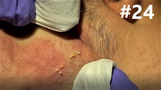 BLACKHEADS on Happy 24 [upl. by Anees701]