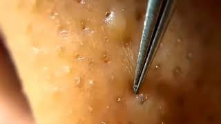 BLACKHEADS AND WHITEHEADS REMOVAL BY TWEEZERS [upl. by Enaols]